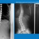 That Was Then… This is NOW! – New Hope for Scoliosis Patients