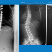That Was Then… This is NOW! – New Hope for Scoliosis Patients